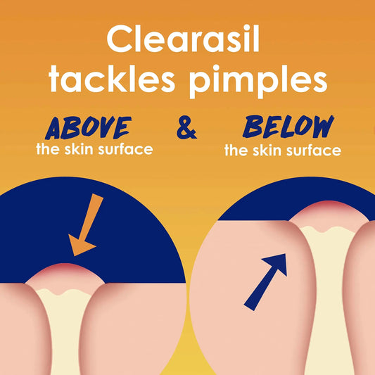 Clearasil Stubborn Acne Control 5in1 Spot Treatment Cream, Maximum Strenght with 10% Benzoyl Peroxide, Acne Medication, 1 oz 1 Ounce (Pack of 1) - Vivareflex Online