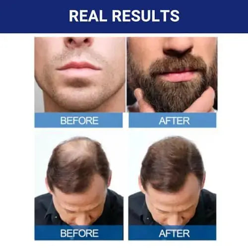 Minoxidil for Men - 5% Extra Strength Hair Regrowth_Vivareflex_Online