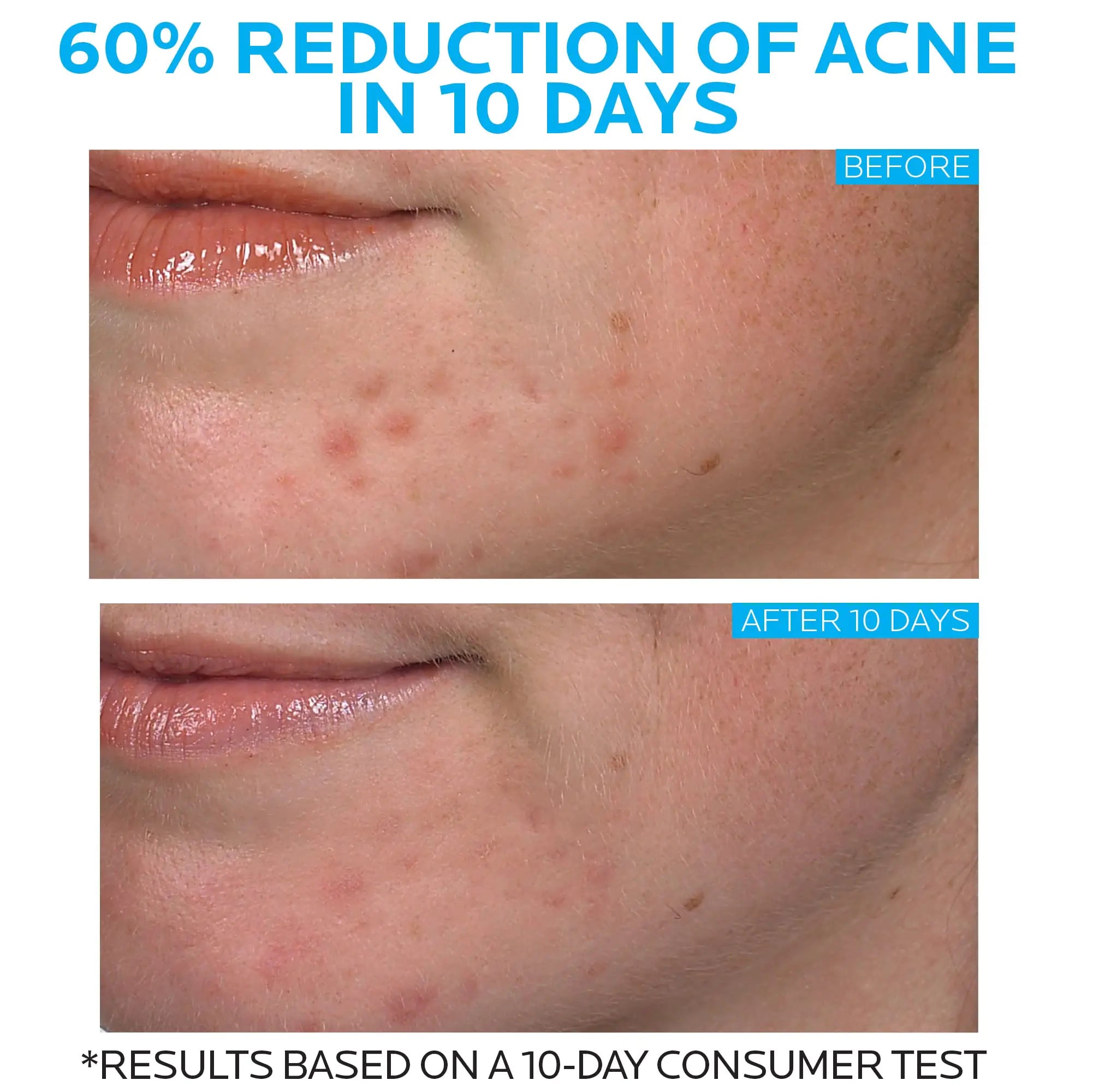 La Roche-Posay Effaclar Duo Acne Spot Treatment with Benzoyl Peroxide - Dual Action for Clear Skin - Vivareflex Online