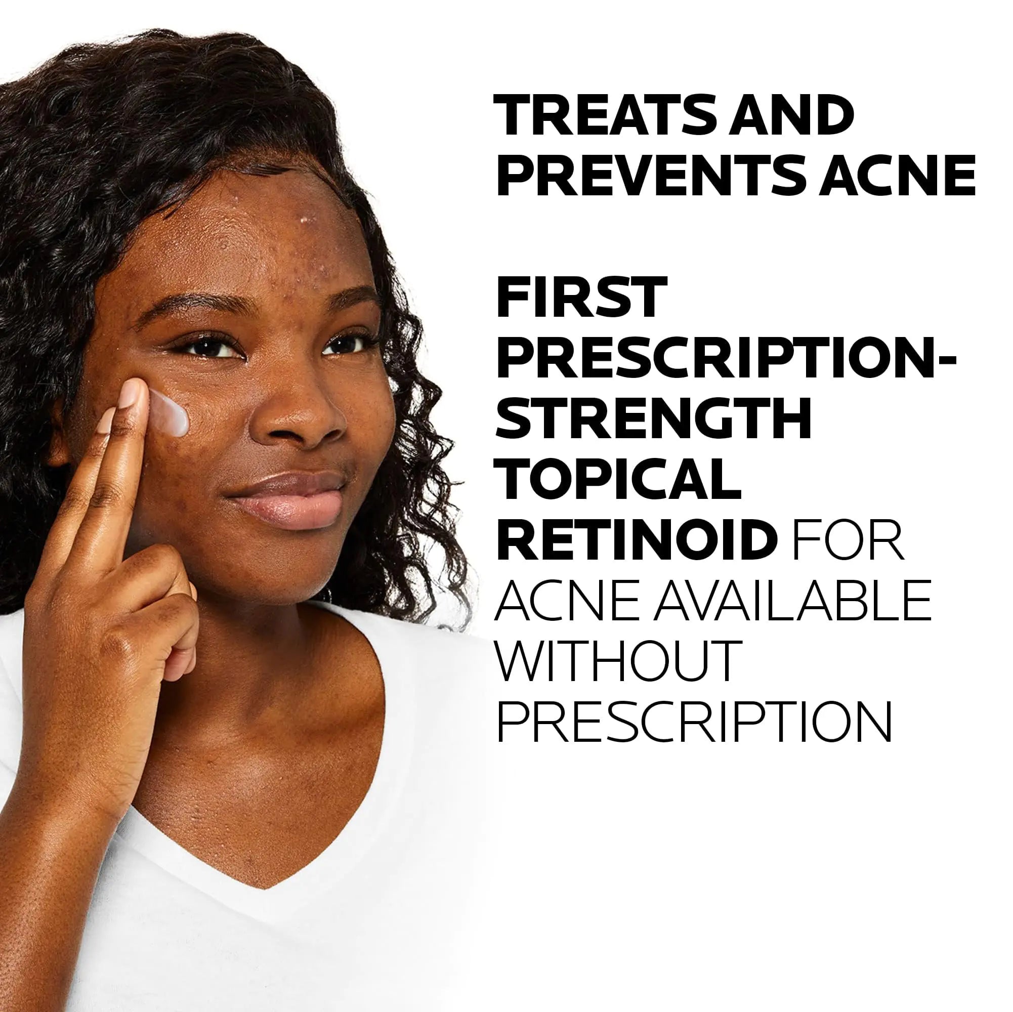 La Roche-Posay Effaclar Adapalene Gel 0.1% Acne Treatment - Retinoid Acne Cream for Clearer Skin