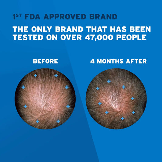 Rogaine Extra Strength Minoxidil Solution - Vivareflex Online